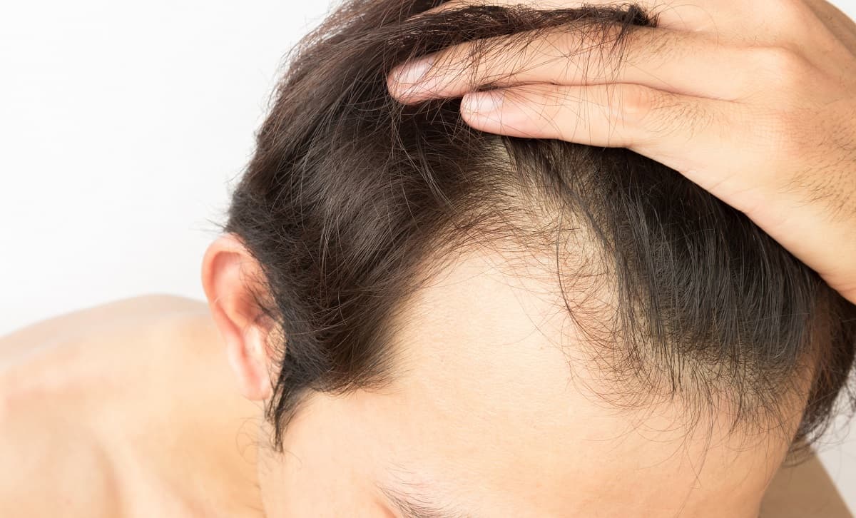 Testosterone and Hair Loss in Males: What's the Link?