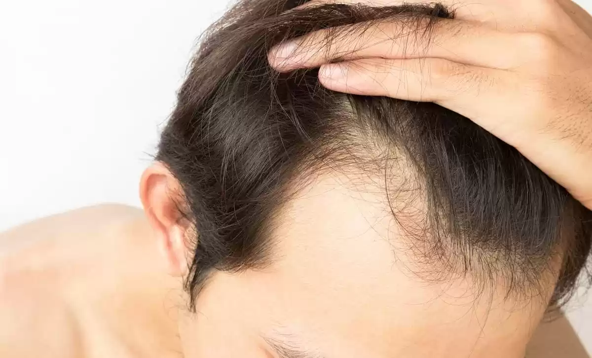 low testosterone and hair loss man shows the area of hair loss